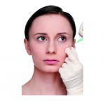 Mid-facial augmentation with a volume filler