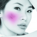 Dermal filler treatment for atrophic acne scarring