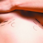 Fat grafting and breast operations: 70% of surgeons use technique