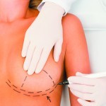 Correcting breast implant complications using TIGR® long-term synthetic mesh