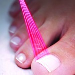 Treating nail conditions with laser therapy