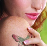 Tattoo removal with Ellman’s Tri-Lase System