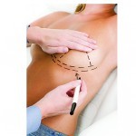 Breast augmentation: novel techniques, new implants, and an update on complications