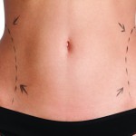 Gastric bypass should include body contouring