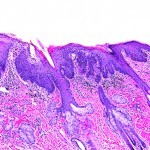 Study highlights physician preference for topical treatments for actinic keratosis