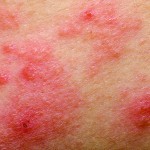 Shaping the skin microbiome