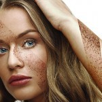 Melasma: the most common pigmentary disorder