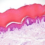 Breaking bacterial biofilm layer could resolve serious skin infections and save lives