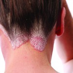 New strategies for the treatment of psoriasis