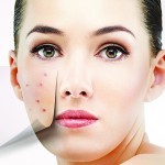 Revisiting acne vulgaris