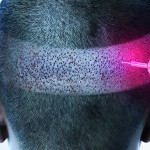 Robotics, artificial intelligence, and the future of hair transplantation