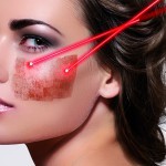 Treating post-inflammatory hyperpigmentation