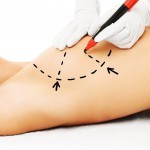 Advancements in breast reconstruction