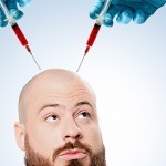 Autologous PRP injection in androgenic alopecia
