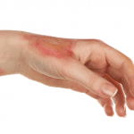 Better outcomes using cultured, self-donated, epidermal cells for serious burn victims