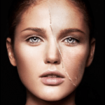 Pathophysiology of Chemical Peels
