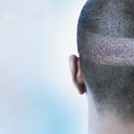 Treatments for male pattern hair loss