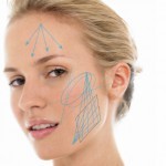 Liquid Facelift with APRILINE® HA Fillers
