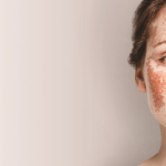 Treating hyperpigmentation using a combination of hyaluronic and succinic acids