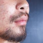 The treatment of acne scars
