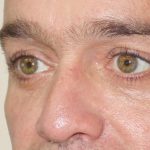 Treating the periorbital region