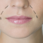 How to achieve optimal perioral correction
