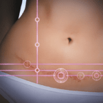 Trends in abdominoplasty