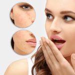 New survey reports on acne, social media behavior and teenagers’ self-esteem
