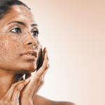 Facial hyperpigmentation in skin of colour