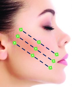 The Use of Absorbable Sutures for Suspension and Volumising