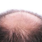 Soft Hair Surgery