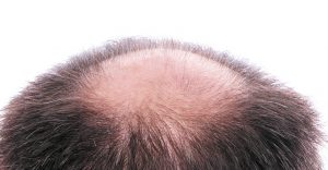 Soft Hair Surgery