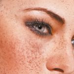 Treating Melasma Effectively Using a Controlled, Individual Bleach-Peel