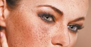 Treating Melasma Effectively Using a Controlled, Individual Bleach-Peel
