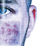 The Treatment of Rosacea Using the Vbeam Prima 595 Nm Pulsed-Dye Laser