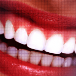 Plasma Exeresis – A Novel Approach to Treat Gummy Smile