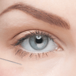 Periorbital Rejuvenation with Hyaluronic Acid Fillers