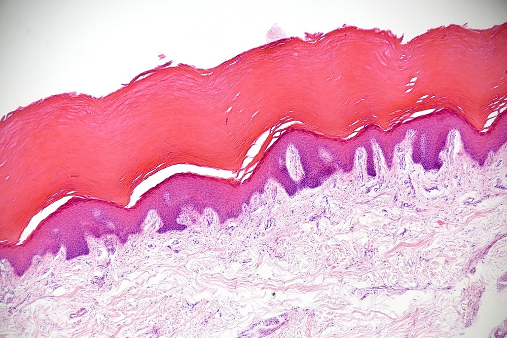 Breaking bacterial biofilm layer could resolve serious skin infections ...