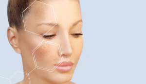 Scientis unveil cysteamine 5% study results